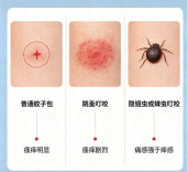 夏季蚊虫叮咬别乱挠！辨虫处理避误区，护好肌肤不留疤
