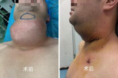 切除巨大甲状腺恶性肿瘤！娄底市中心医院再破头颈手术难题