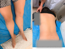 离谱又神奇！长沙50岁大姐治腰腿痛，意外“治好”10年顽固银屑病