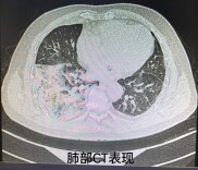 湘雅三医院感染科联合精准医学中心 44 小时确诊救治一例鹦鹉热患者