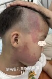 5岁娃在湖南省儿童医院无痛光动力祛除红胎记