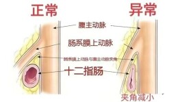 长沙女孩盲目减肥患上十二指肠淤滞症，医生提醒：这些红线别碰