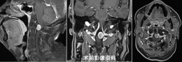 勇闯“生命禁区”，岳阳市中心医院脊柱外科成功切除颅颈交界区脊膜瘤