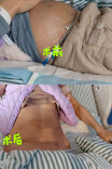 肝硬化引发顽固性乳糜腹水 微创介入TIPS手术精准解忧