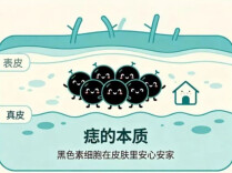 你的痣安全吗？试试ABCDE自测法
