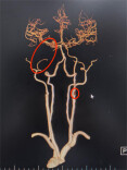 双侧颈动脉同时“告急”， 长沙三医院抢通生命通道