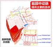邵阳市中心医院神经外科开展脑膜中动脉栓塞术，助力慢性硬膜下血肿诊疗水平提升