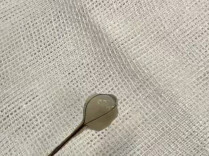 11岁女孩咳嗽久治不愈，CT惊现左肺藏“乳牙”！医生提醒：换牙期当心吸入异物！