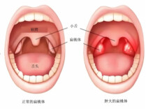 扁桃体：切，还是不切？看完这篇不再纠结！