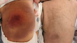 出生时的“胎记”疯长，原来是一种罕见的血管源性肿瘤