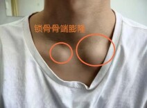 痘痘久治不愈，病根或许不在皮肤