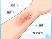 健康科普 | 反复瘙痒困住生活？带您科学认识荨麻疹