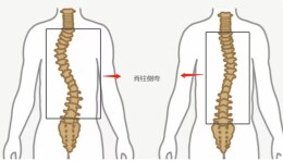 揭示青少年脊柱侧弯问题：不良姿势成罪魁祸首？
