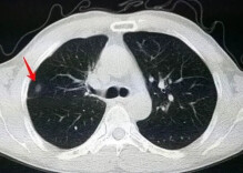 这三类人最容易长结节，一文告诉你，发现结节怎么办！