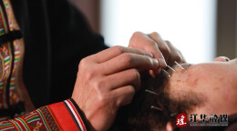 江华：颊针疗法获推广