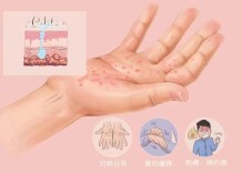 每年准时来报到，如何摆脱这难缠的汗疱疹？