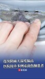 连续阴雨天湿度偏高，医院接诊多例霉菌伤肺患者