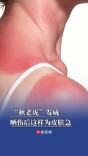 “秋老虎”发威，晒伤后这样为皮肤急救