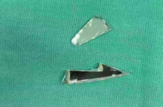 女孩不走寻常路，摔下4楼险被玻璃刺入大动脉