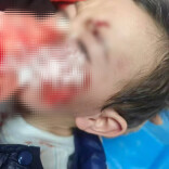 春节期间动物致伤频发，2岁宝宝面部被撕裂