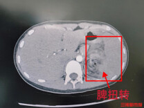 12岁女童腹痛呕吐，竟是罕见脾扭转致脾脏切除