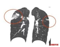 无症状≠没病，警惕“结核潜伏感染无症状”陷阱