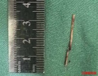 疑似“肿瘤”却查不出癌细胞，竟是一根鱼刺在作怪