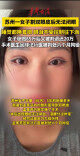 苏州一女子割双眼皮后无法闭眼