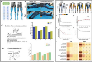 成效显著！湘雅二医院创新性应用脊髓电刺激于中枢性痉挛治疗