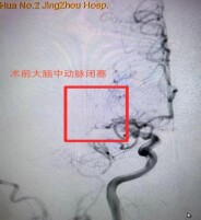 争分夺秒 介入取栓术助力急性脑梗患者转危为安