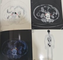 盆腔肿瘤缠身四处求医！58岁阿姨轮椅入院，经治疗重新站立行走