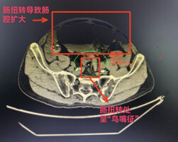 81岁老人腹胀如鼓！内镜微创化解肠梗阻