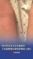 特应性皮炎不是普通湿疹，专家：别让瘙痒影响孩子成长