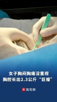 女子胸腔取出2.3公斤巨型畸胎瘤，相当于50多个鸡蛋！医生提醒：定期胸检不可少