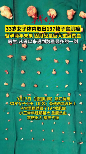 33岁女子体内取出197枚子宫肌瘤
