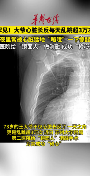 73岁大爷心脏长反了，每天乱跳超3万次