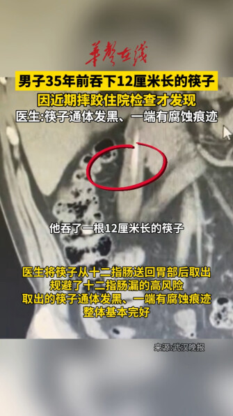 男子35年前吞下一根筷子近期才发现