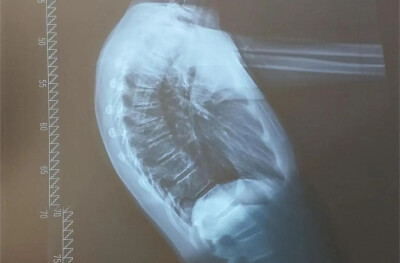 12岁男孩驼成“虾”！医生提醒：这姿势别再做了