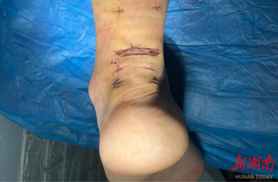第45天下地、第77天日行万步！益阳医专附属医院微创术为跟腱患者按下康复“快进键”