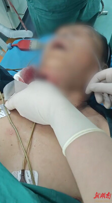 螺纹钢贯穿颅底、脑组织外溢，南华附二周敏医师团队精准应用两项新技术逆转患者生死