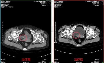 怀化市中心医院多学科协作破局：不开刀，中西医结合技术助急性输尿管结石患者快速康复