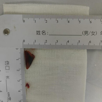 久咳不愈 竟因一块呛进肺的辣椒皮