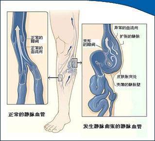 静脉曲张的治疗原来可以这样做！