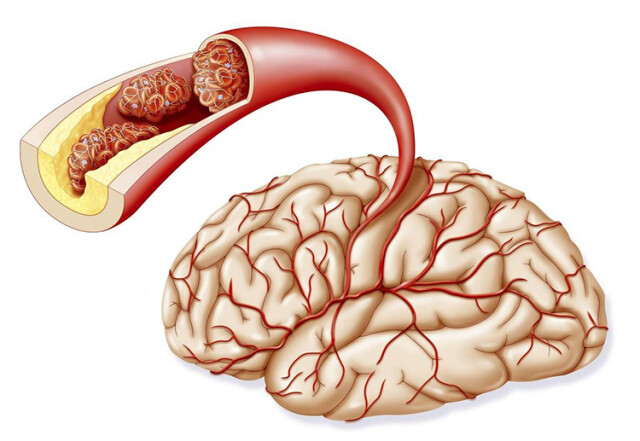 湖南省“心脑血管疾病防治协同创新工程”研究取得新进展