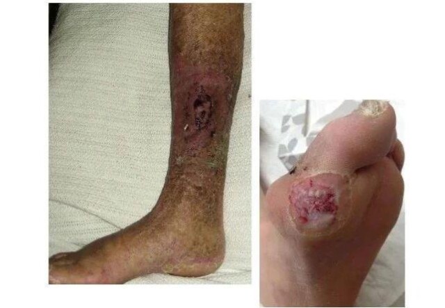 警惕！糖尿病也可引发癌症……