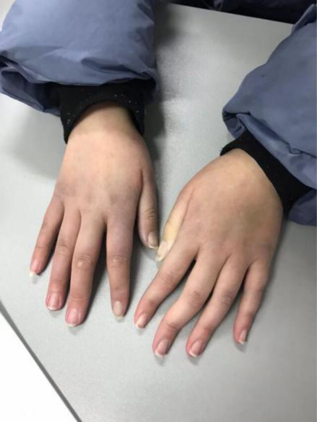 美丽“冻”人，湿冷天气当心风湿病加重