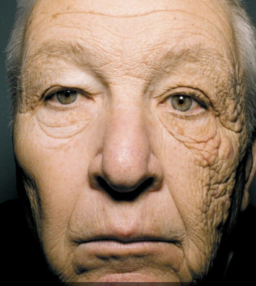 防晒只是防黑?专家：更重要谨防皮肤病变!