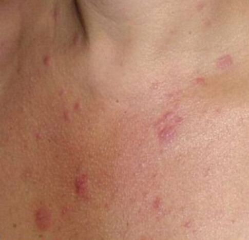 防晒只是防黑?专家：更重要谨防皮肤病变!