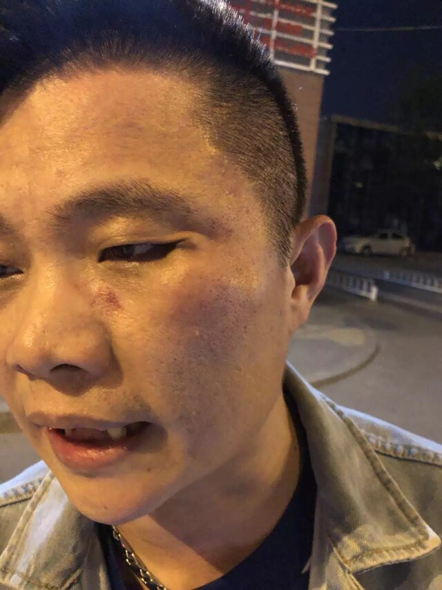 张桓:我被滴滴司机打的左眼软组织塌陷