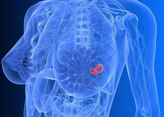 体检查出"乳腺增生"怎么办